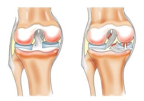 healthy knee and arthrosis of the knee joint